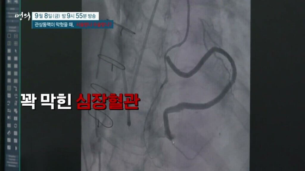 관상동맥 스텐트 시술 후 완치 훈련